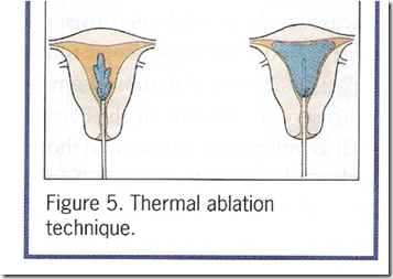 endometrial ablation disorders menstrual hysterectomy